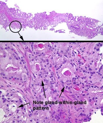 NeedleBiopsyprostate_zps08833468.jpg